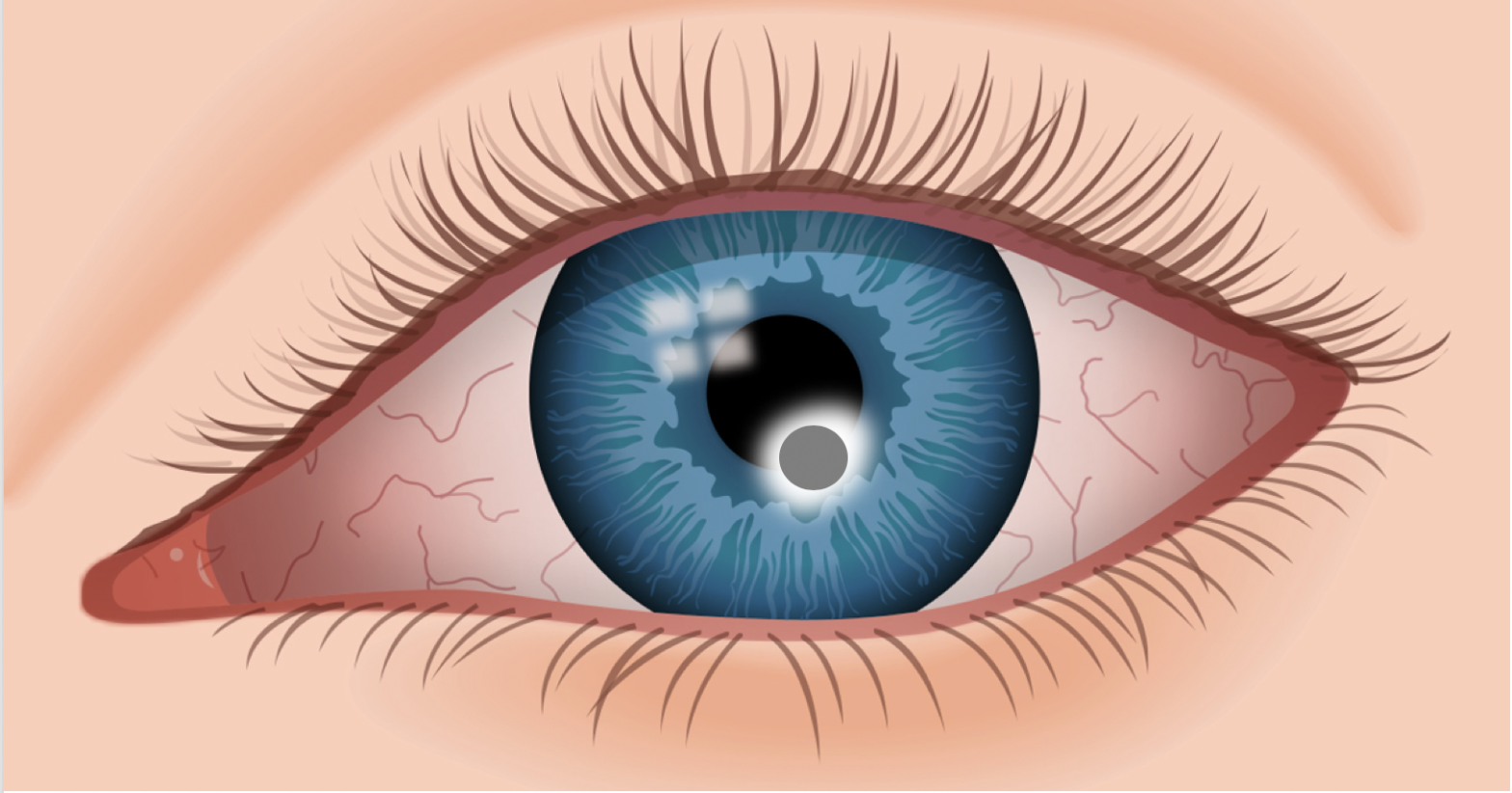 Corps étranger oculaire - SOS Oeil