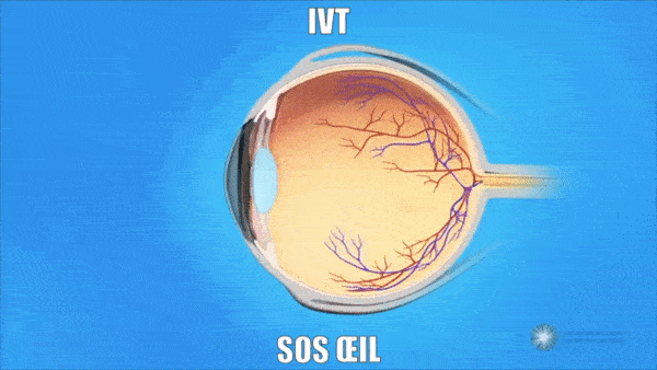 Injection intravitrenne - IVT - Traitement de l'dme maculaire